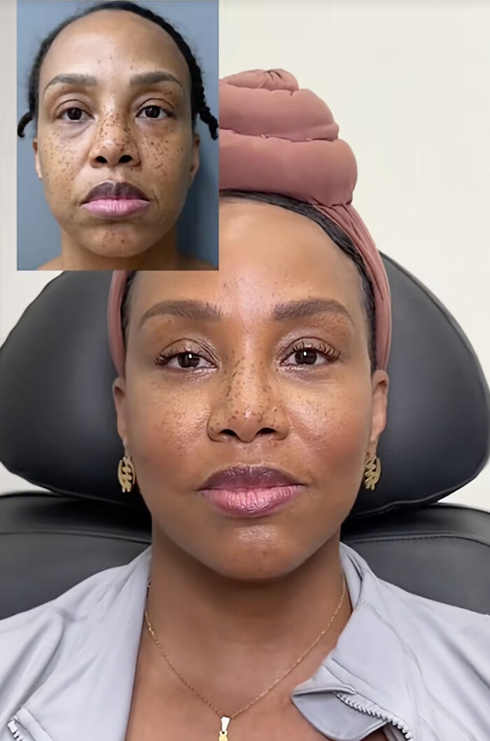 Before and after plastic surgery transformation of a woman sharing her results online as part of a change journey.