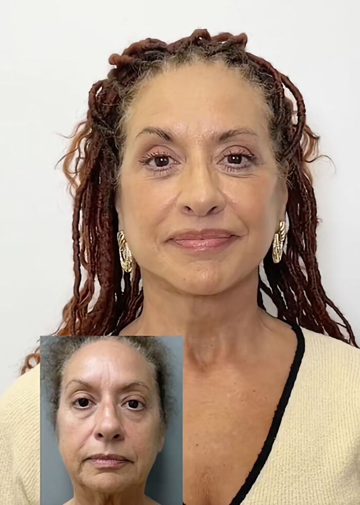Before and after photos of a woman showing results of plastic surgery transformation shared online.