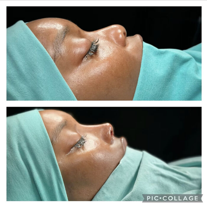 Side-by-side before and after photos showing plastic surgery results on a person's nose and facial profile.