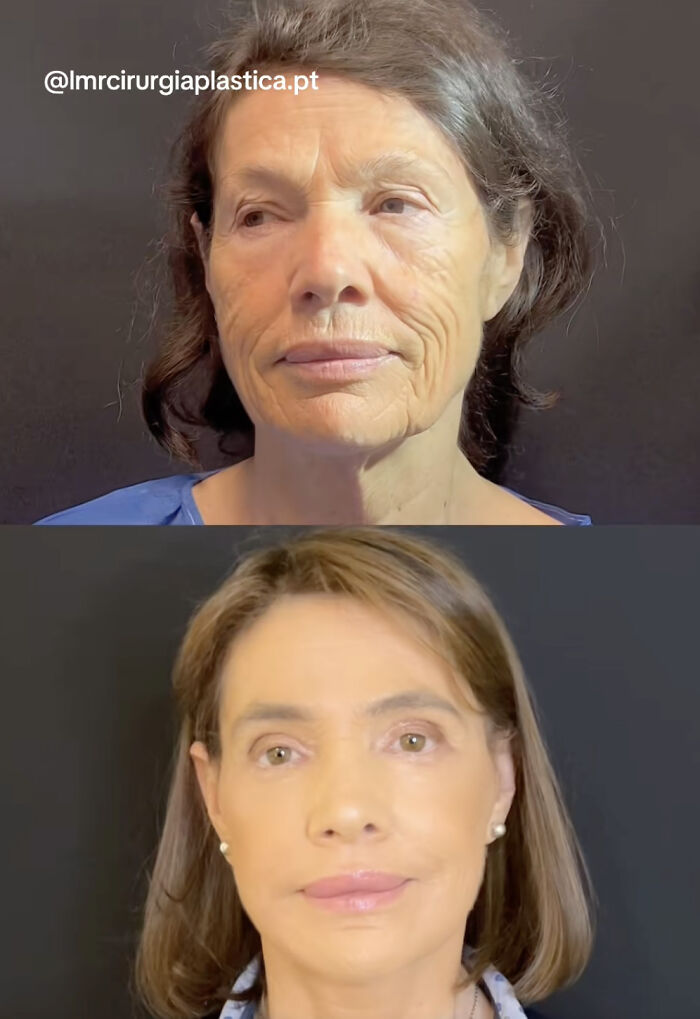 Before and after plastic surgery transformation showing dramatic facial rejuvenation and skin smoothing results.