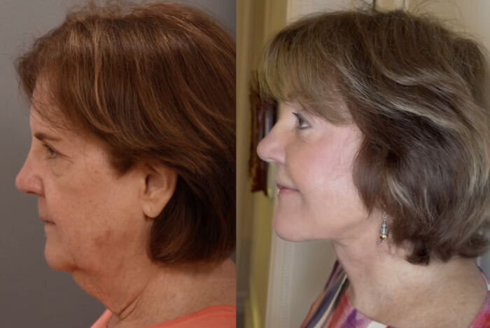Before and after side profile of a middle-aged woman showing plastic surgery results and transformation.