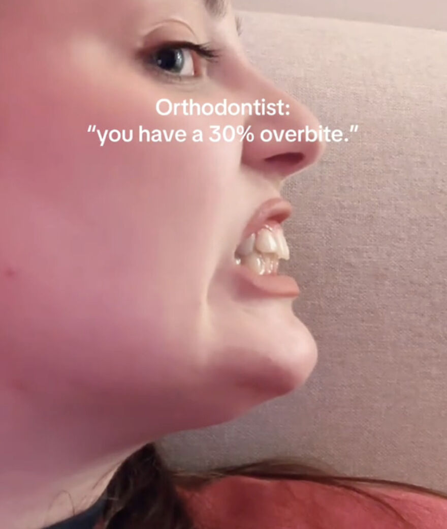 Close-up of a person showing a 30 percent overbite, sharing perfect imperfections in a wholesome trend.