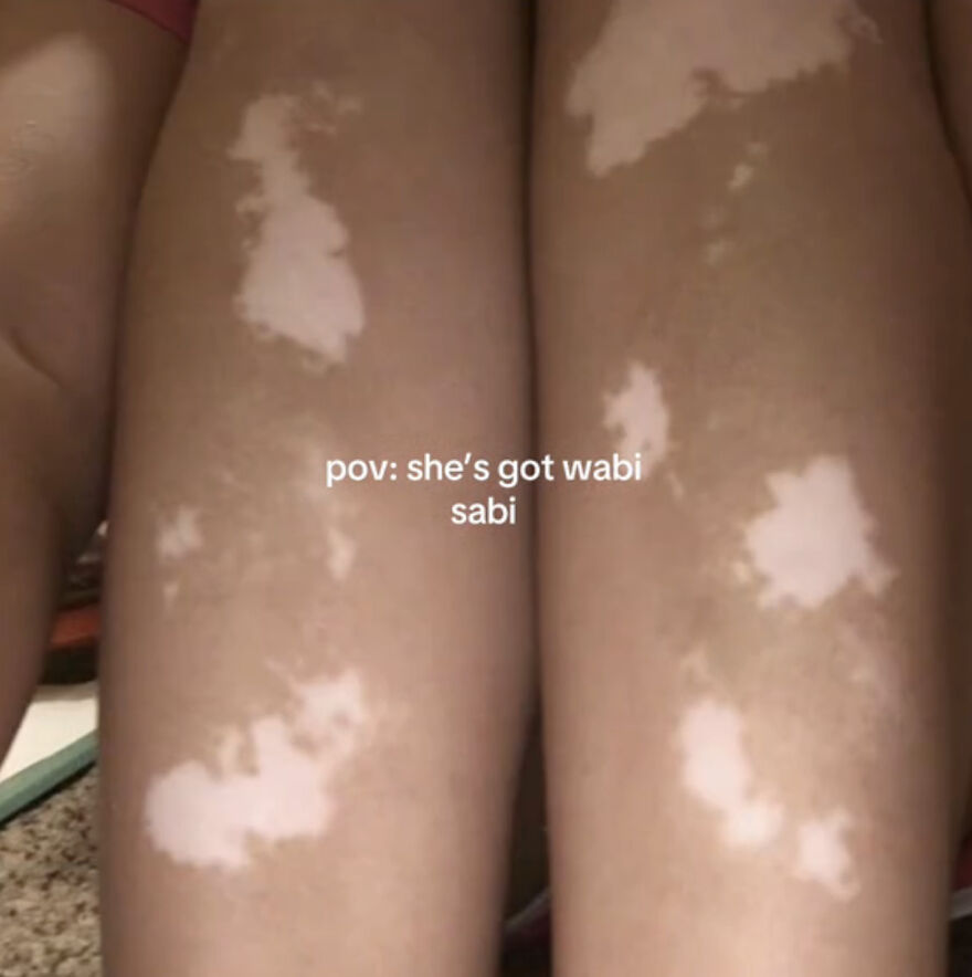 Close-up of legs with vitiligo patches, celebrating perfect imperfections in a wholesome self-acceptance trend.