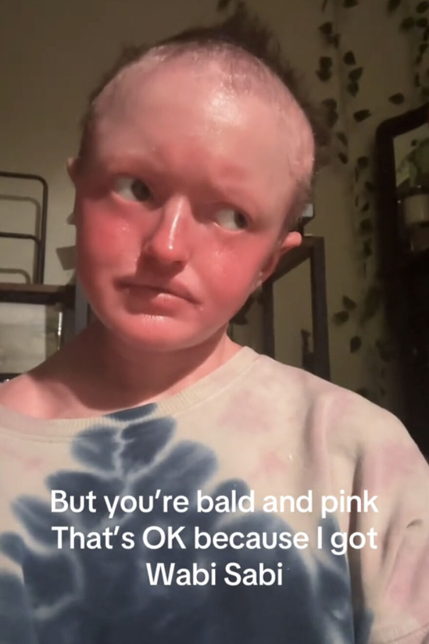 Person with a bald head and pink skin proudly embracing perfect imperfections in a cozy indoor setting.