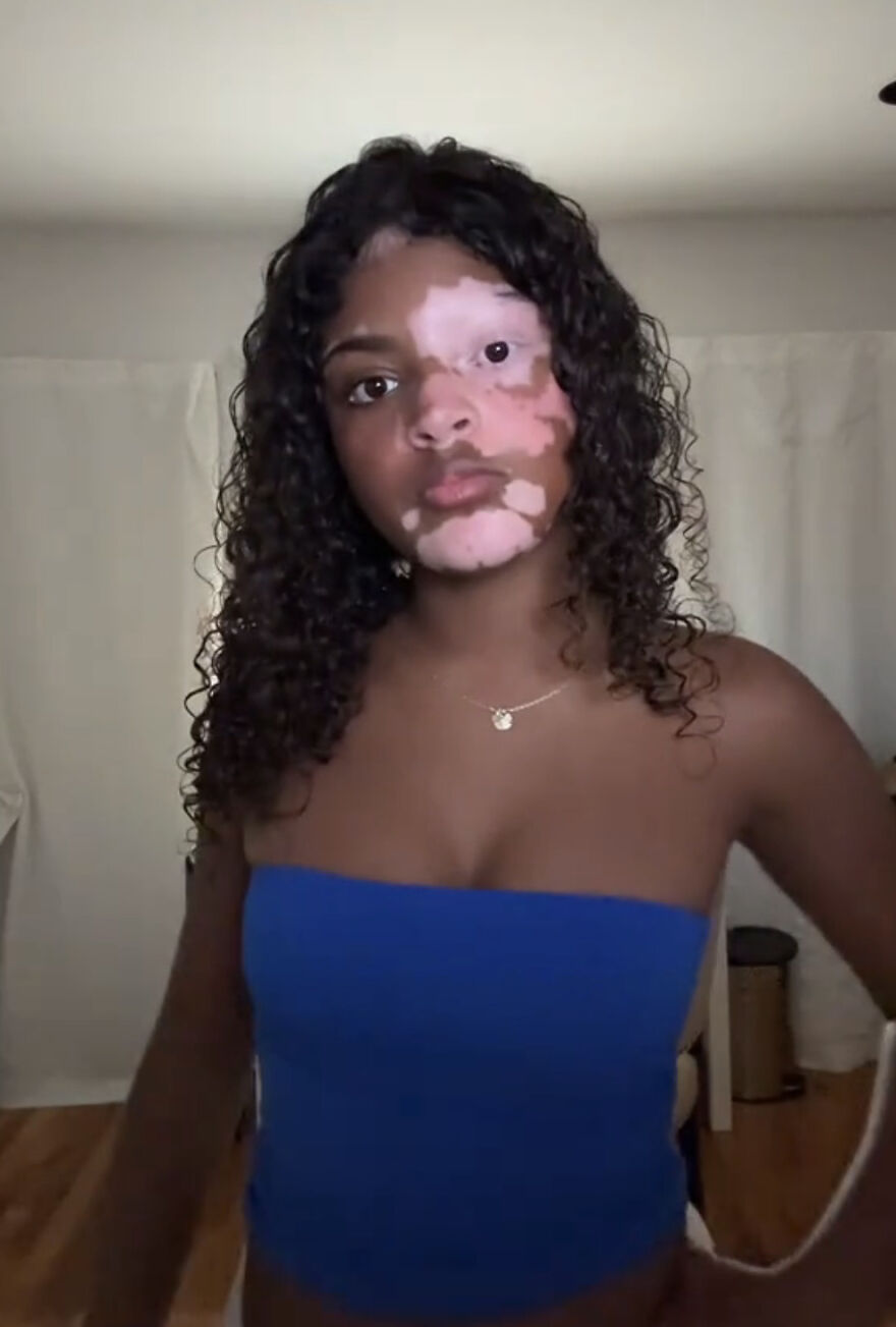 Young woman with vitiligo confidently posing indoors, showcasing perfect imperfections and embracing a wholesome trend.