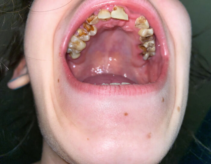 Close-up of a mouth showing severely decayed teeth, related to wildest patient horror stories dentists still think about.