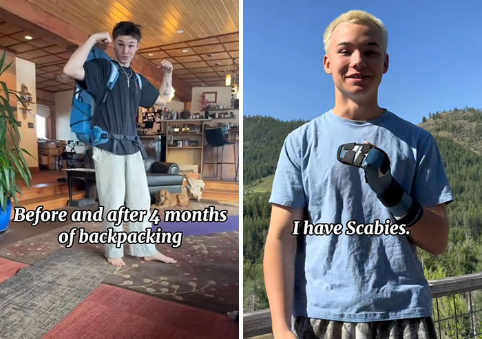 Young traveler before and after long-term backpacking, showing physical changes and a health condition outdoors.