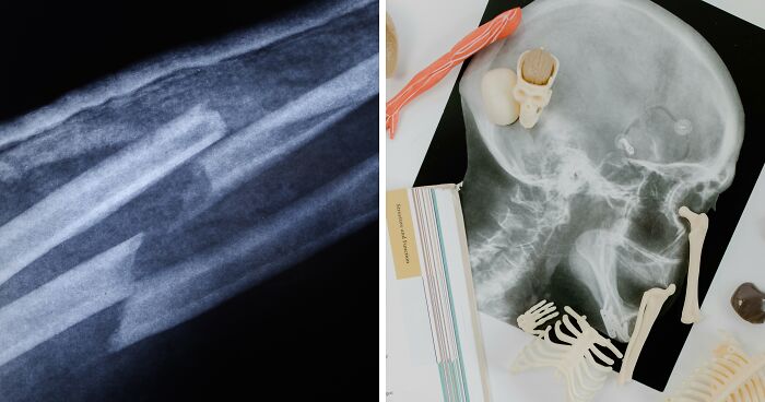 Broken Bone Theory: The TikTok Trend Making Superstition Weirdly Hilarious