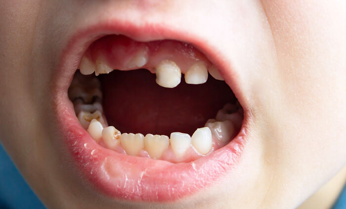 Close-up of a child's mouth with dental decay and missing teeth, illustrating wildest patient horror stories dentists encounter.