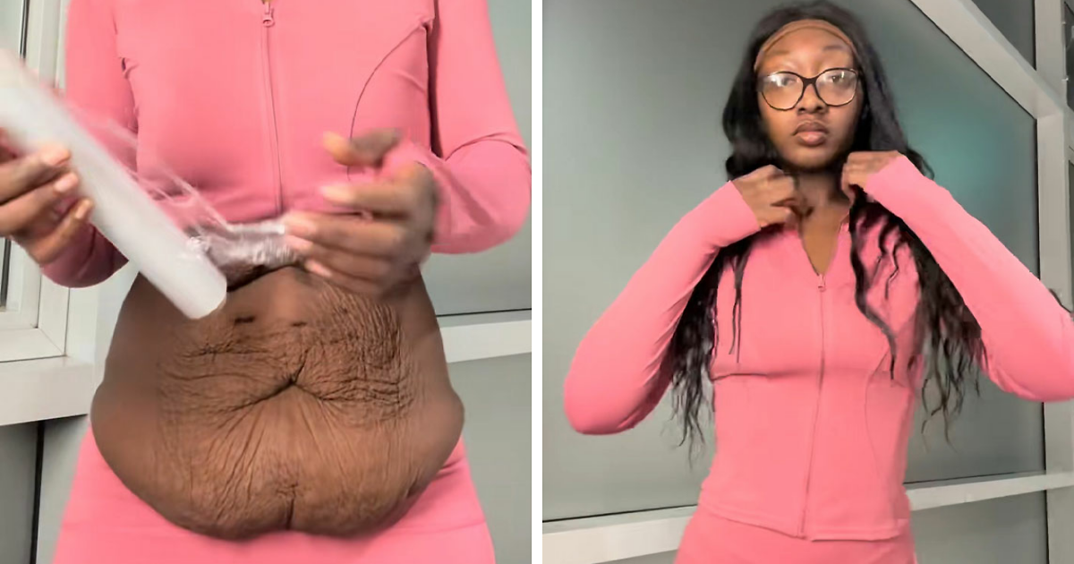 Woman's Trick To Hide Loose Skin On Her Belly After Massive Weight Loss ...