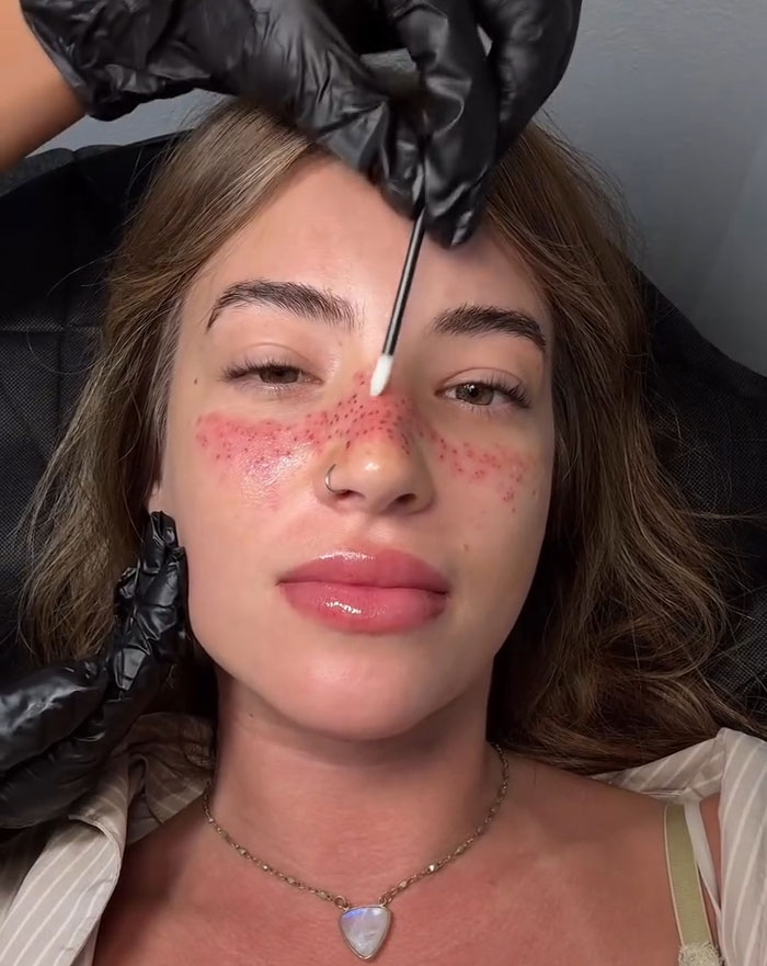 Woman getting freckles tattooed on her face, with red dotted patterns visible on her cheeks and nose during procedure.