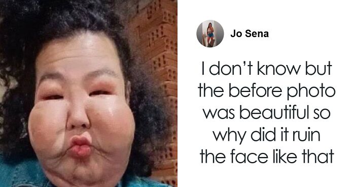 Influencer Stuns Fans With Surgery Update After Botched Procedure Leaves Her Unable To Find Work