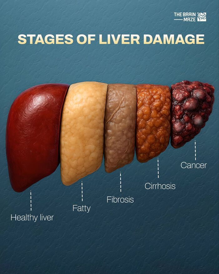 Stages of liver damage from healthy to cancer showing human body facts about liver health and disease progression.