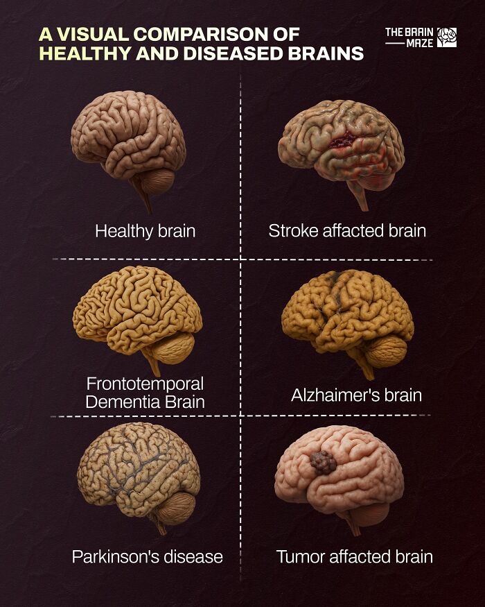 Visual comparison of healthy and diseased brains showcasing brain conditions for human body facts and health awareness.