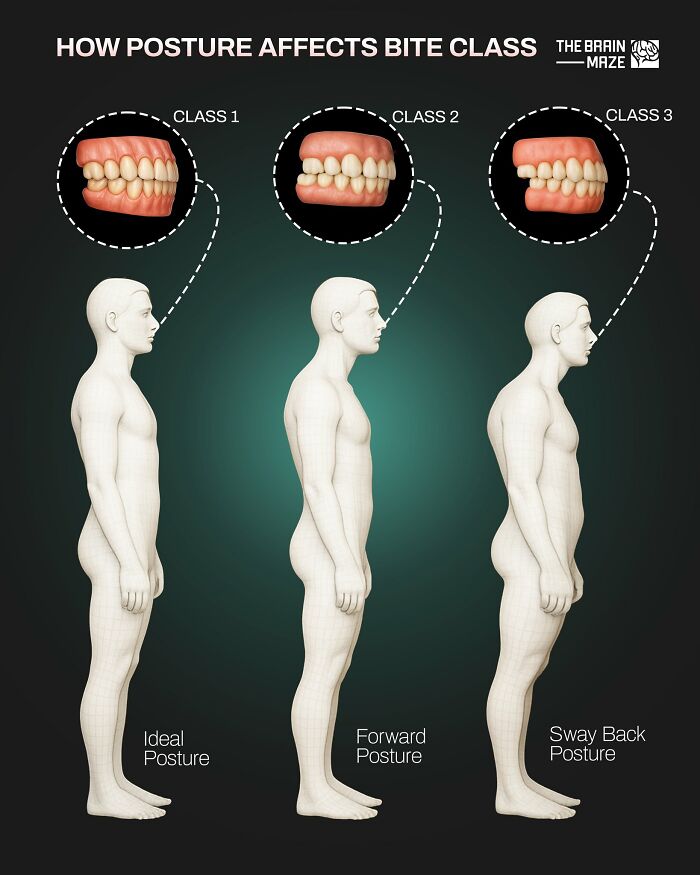 Diagram showing how different postures—ideal, forward, and sway back—affect human bite class and alignment.