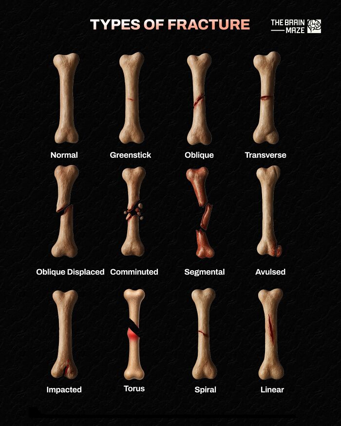 Various types of bone fractures illustrated on human bones, highlighting facts about the human body and fractures.