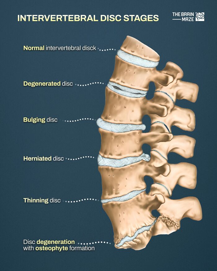 Illustration of intervertebral disc stages in the human body showing normal, bulging, herniated, and thinning discs.
