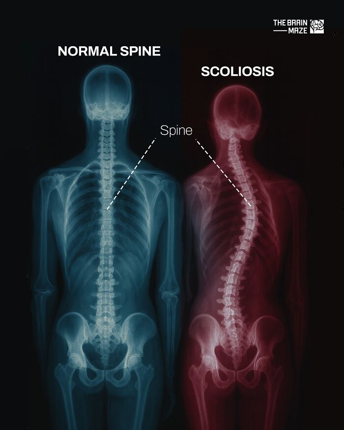 X-ray comparison showing a normal spine versus scoliosis to explain incredible facts about the human body.
