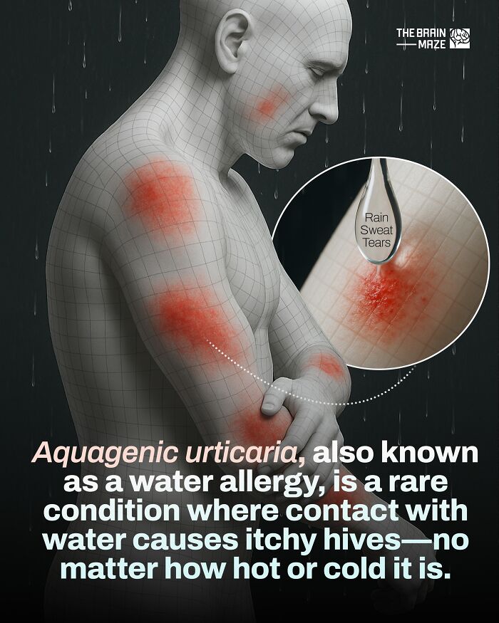 3D model of a man showing aquagenic urticaria, a rare human body condition causing itchy hives from water contact.