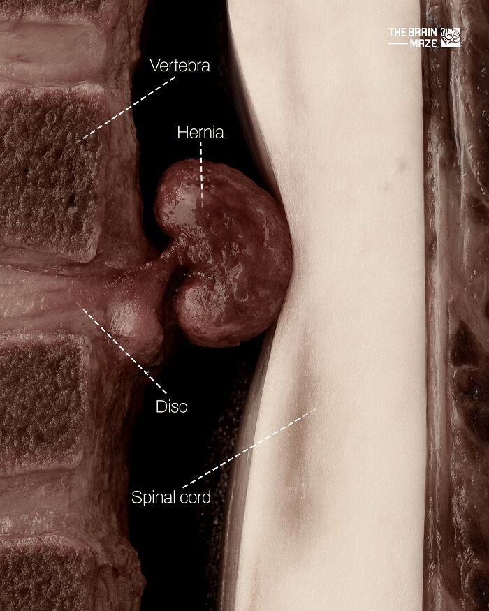Close-up medical illustration showing vertebra, hernia, disc, and spinal cord in the human body anatomy.