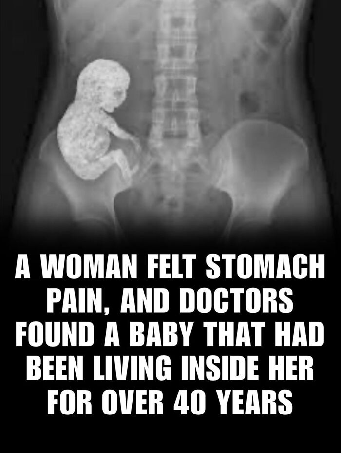 X-ray image showing an adult skeleton with a baby-shaped object inside the stomach, related to daily facts and interesting stories.