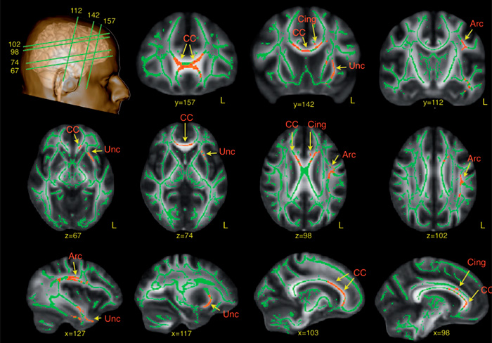 Brain scan images highlighting corpus callosum and cingulate regions in research on whether dogs can be autistic like humans.