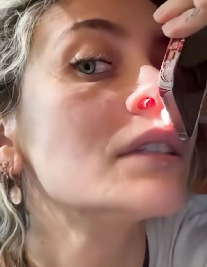 Close-up of a woman undergoing a medical facial examination showing signs of substance use deforming her face and nose.