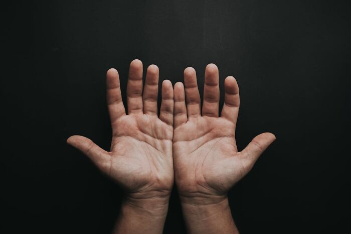 Close-up of open hands with visible lines on palms, symbolizing mysterious medical issues and diagnoses insights.
