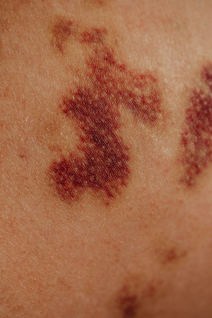 Close-up of mysterious medical skin condition with dark red patches on skin before diagnosis revealed cause.