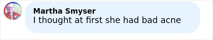 Screenshot of a comment by Martha Smyser saying she initially thought the woman had bad acne after getting freckles tattooed.