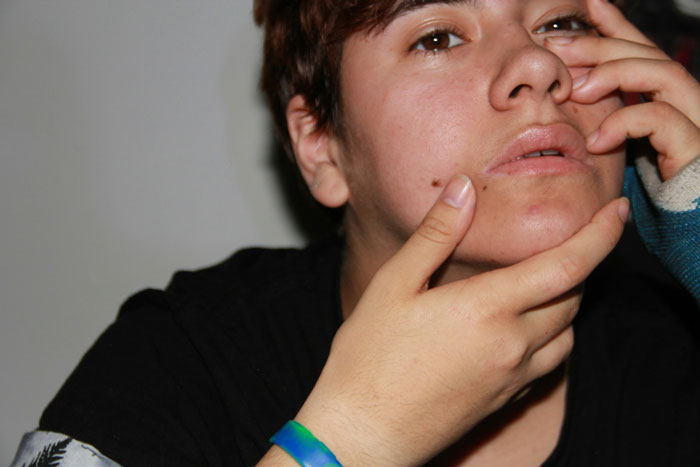 Young boy showing a mole on his face, highlighting concerns about cosmetic surgery and mole removal approval.
