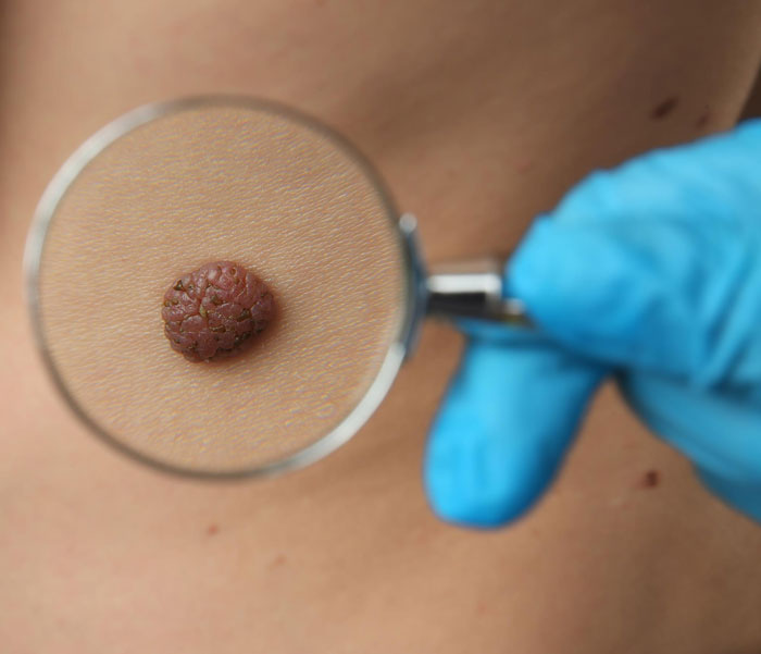 Close-up of a skin mole examined with a magnifying glass by a gloved hand, related to mole removal cosmetic surgery.