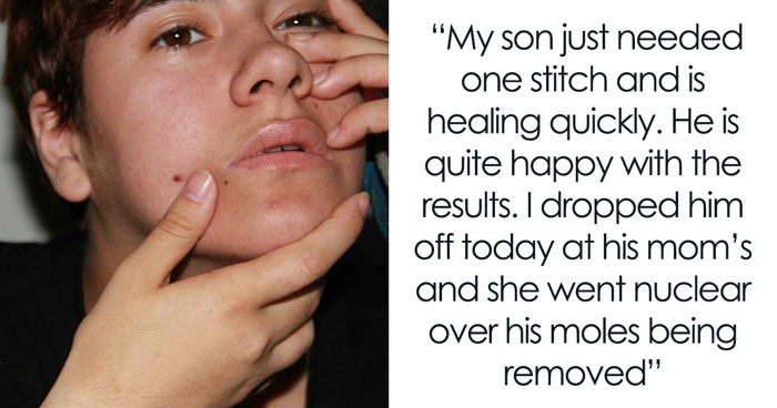 Mom Rages After Ex Removes Son’s Moles Without Telling Her, Says It Was “Cosmetic Surgery”
