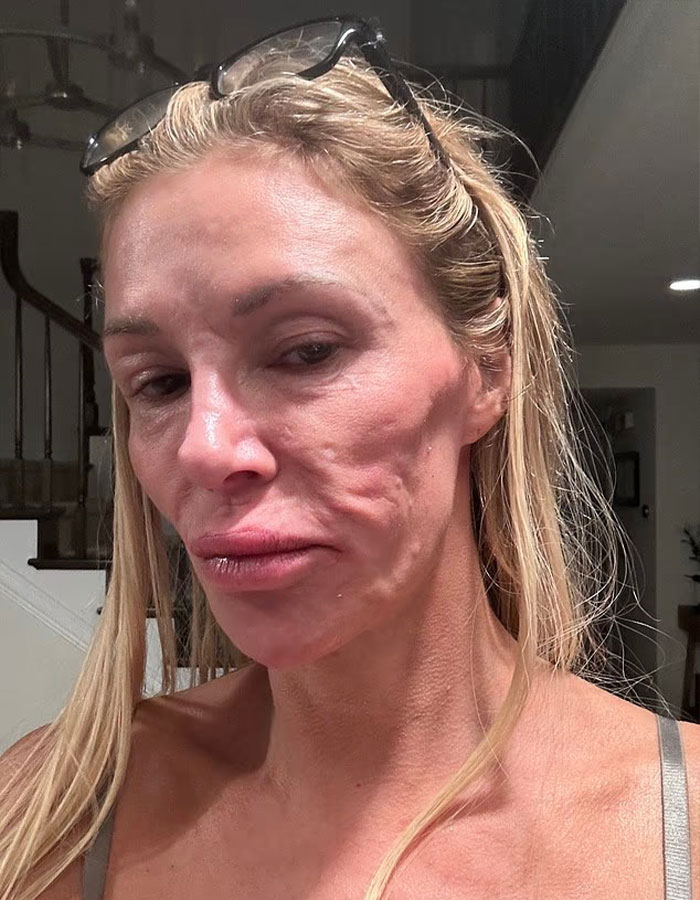 Brandi Glanville showing facial disfigurement with visible skin texture irregularities indoors.