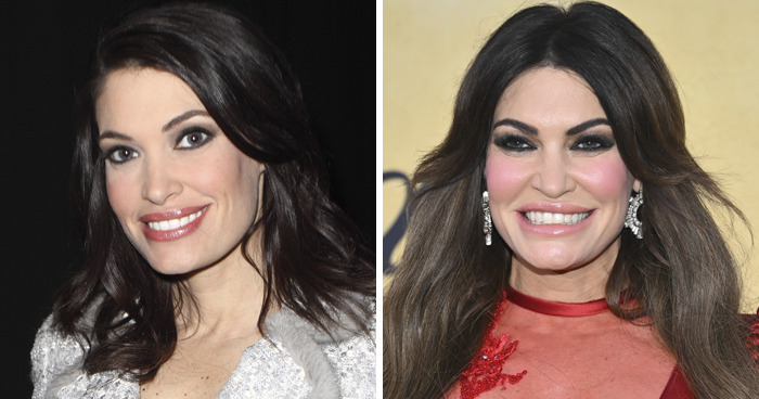 Before and after photos of a female celebrity illustrating changes linked to plastic surgery experiences.