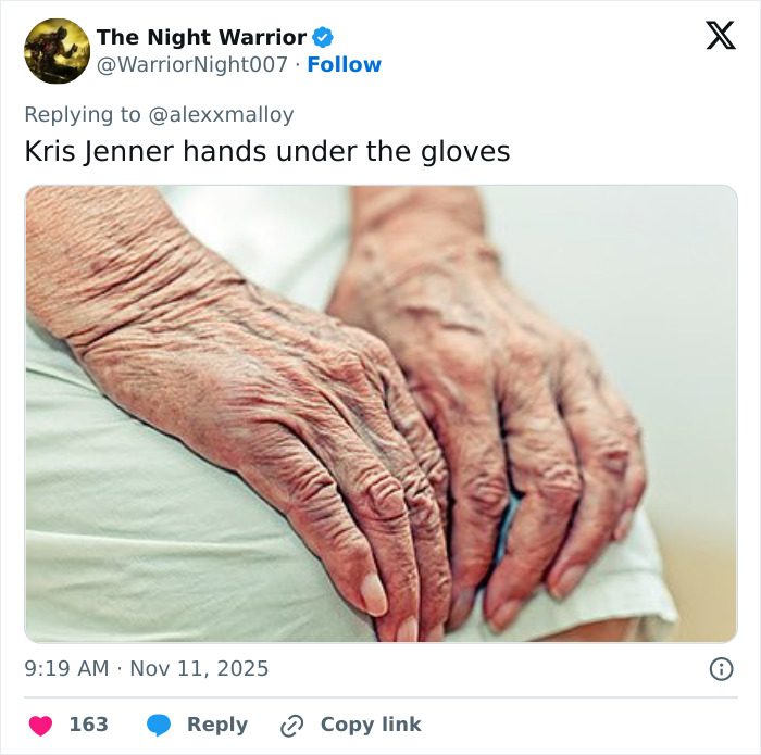 A close-up of aging hands showing wrinkles and veins, highlighting hands after viral $100k facelift reveal.