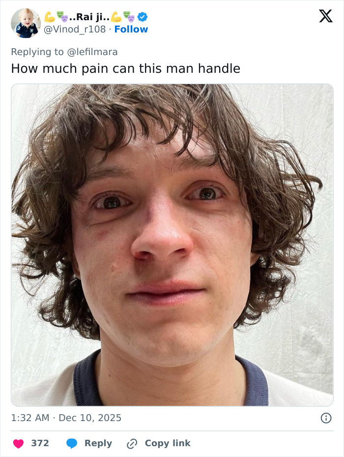 Close-up of young man with bruised face reacting to Robert Pattinson and Zendaya engagement ring news. Close-up of young man with bruised face reacting to Robert Pattinson and Zendaya engagement ring news.