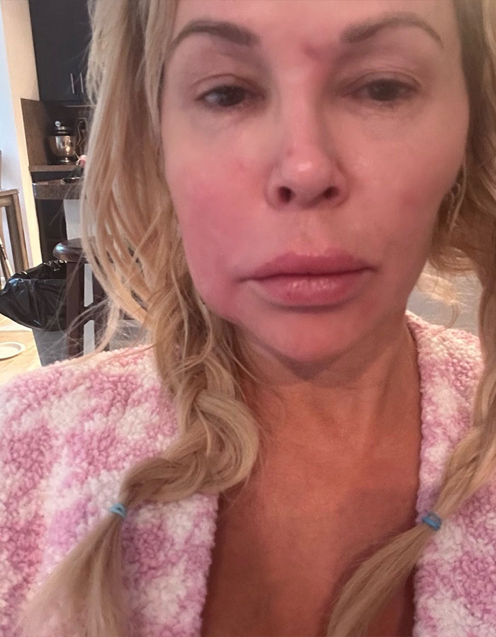 Brandi Glanville showing facial disfigurement after receiving diagnosis following parasite concerns in a casual indoor setting.