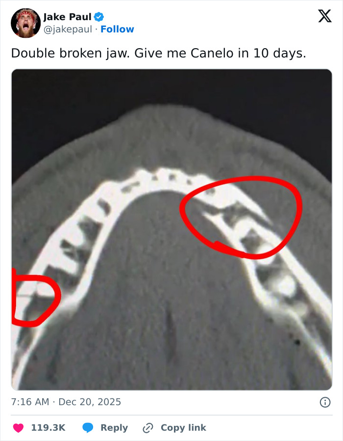 X-ray image showing Jake Paul's broken jaw with two fractures circled in red, highlighting the injury.