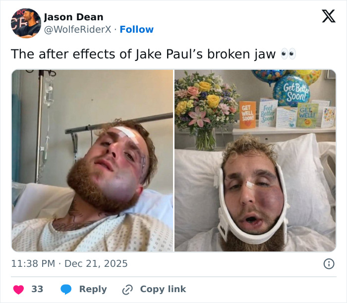 Jake Paul recovering in hospital after broken jaw with visible swelling and medical bandages.