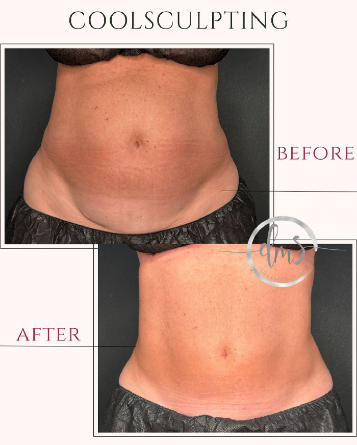 Before and after Coolsculpting photos showing visible reduction in abdominal fat and smoother skin texture.
