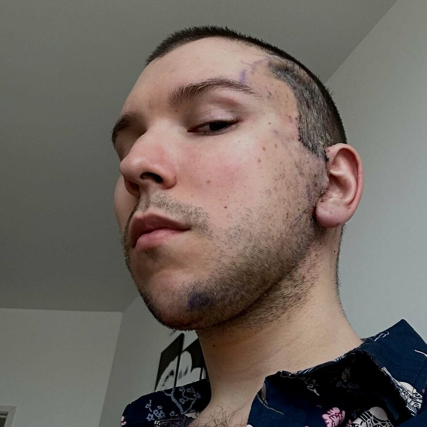 Close-up of a Nikocado Avocado showing cosmetic surgery scars and marks on his face, highlighting Nikocado Avocado cosmetic surgery results.