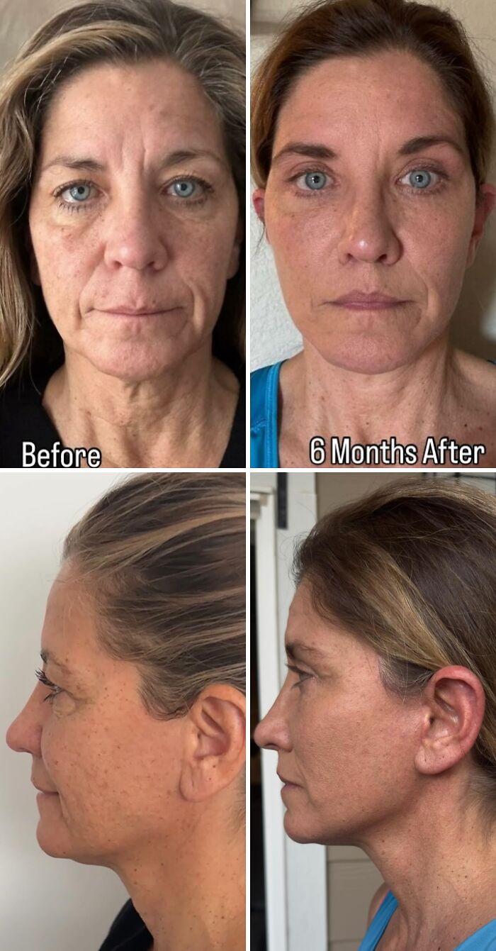 Side-by-side before and after photos showing cosmetic surgery results on a woman’s face after 6 months in Turkey.