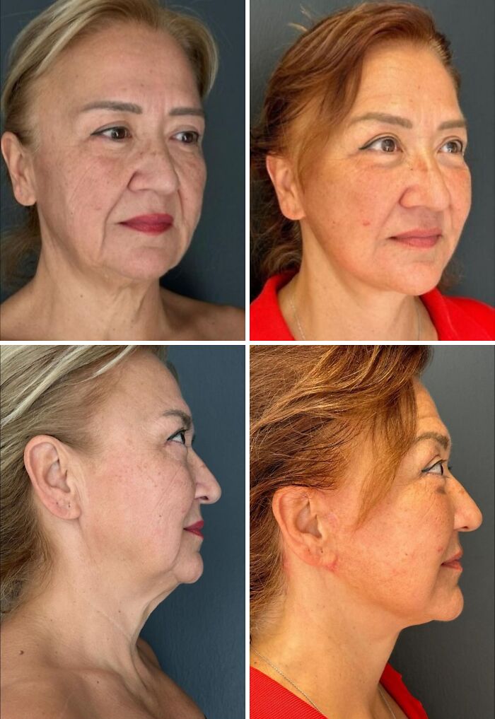 Before and after cosmetic surgery in Turkey showing facelift results on middle-aged women from multiple angles.