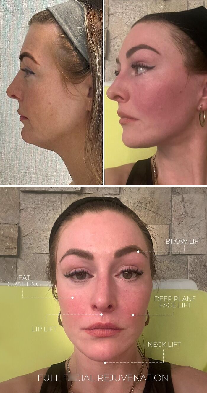 Side and front views of a woman after cosmetic surgery in Turkey showing facial rejuvenation and lift procedures.