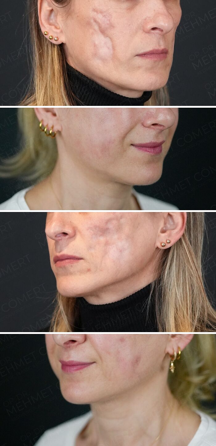 Before and after images showing skin improvement after cosmetic surgery in Turkey for facial scar treatment.