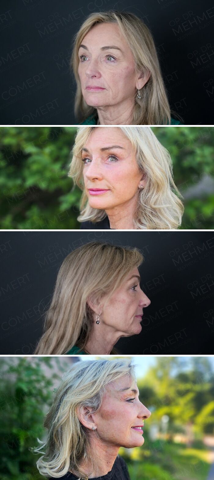 Before and after photos of a woman showing results of cosmetic surgery in Turkey, highlighting facial transformation.