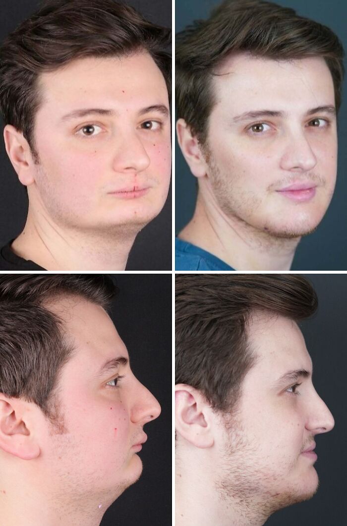 Before and after cosmetic surgery in Turkey showing significant changes in a young man's facial appearance from multiple angles.
