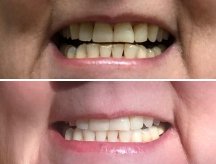 Before and after close-up of a smile showing teeth improvement, related to best sellers in 2025 delusional trends.