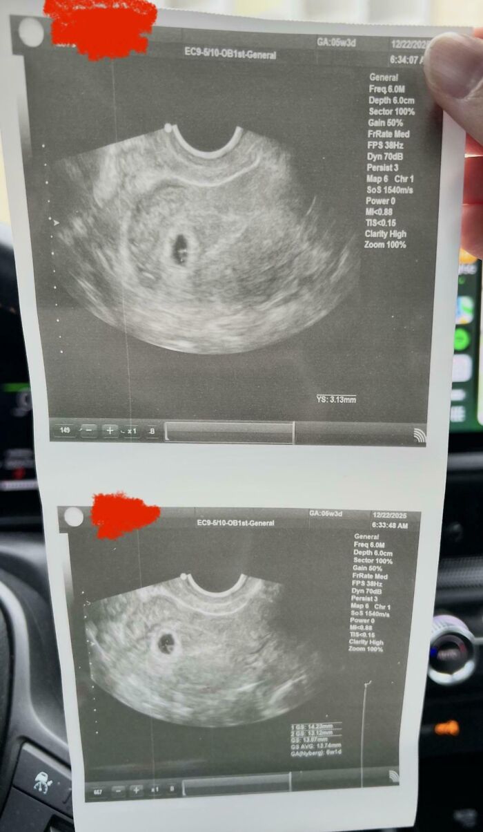 Hand holding ultrasound images capturing one of the sweetest holiday moments that melt even the Grinchiest heart.